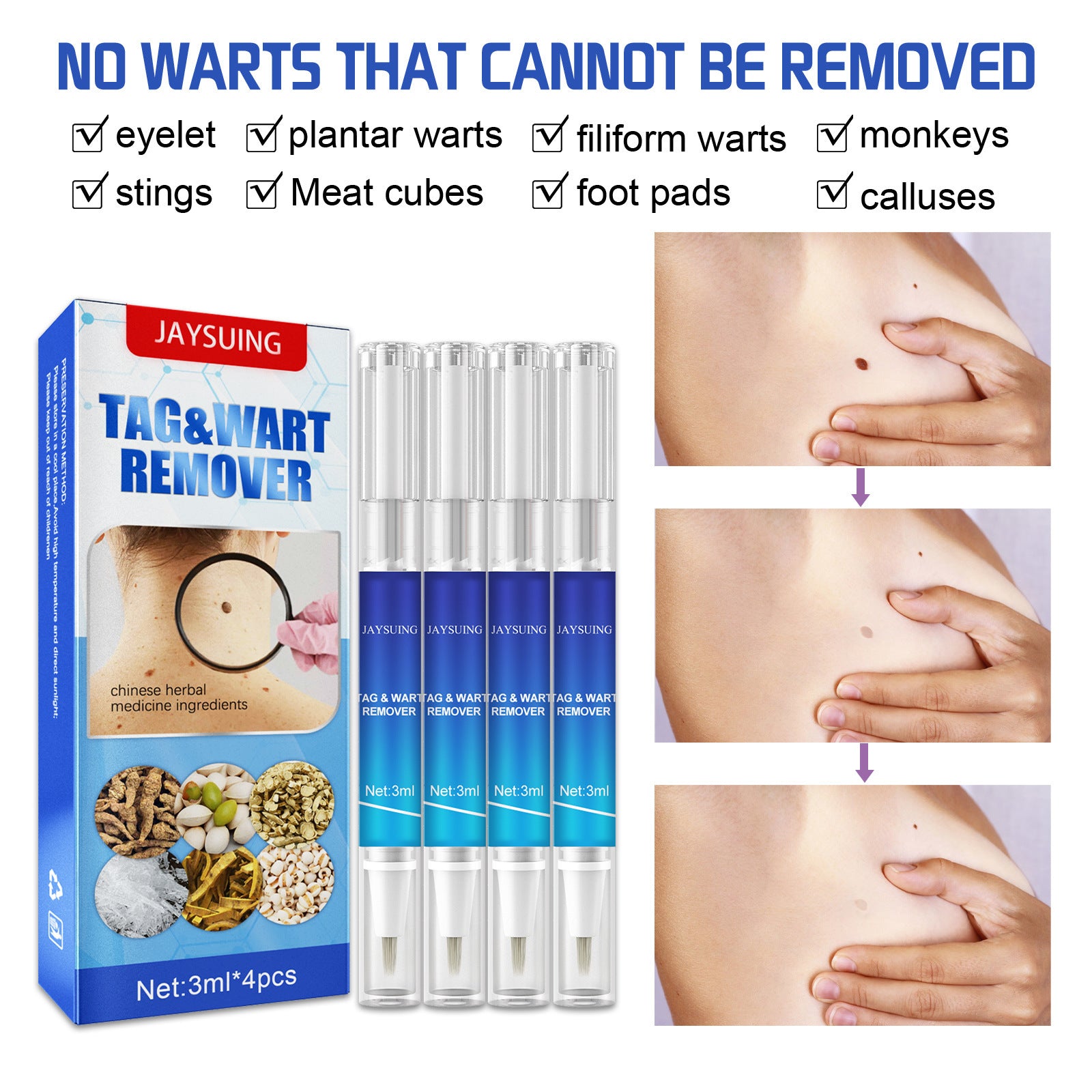 Mole & Wart Removal Pen – Precision Skin Care Treatment