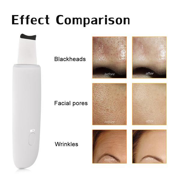Ultrasonic Skin Scrubber Facial Cleaner for Deep Cleansing and Exfoliation