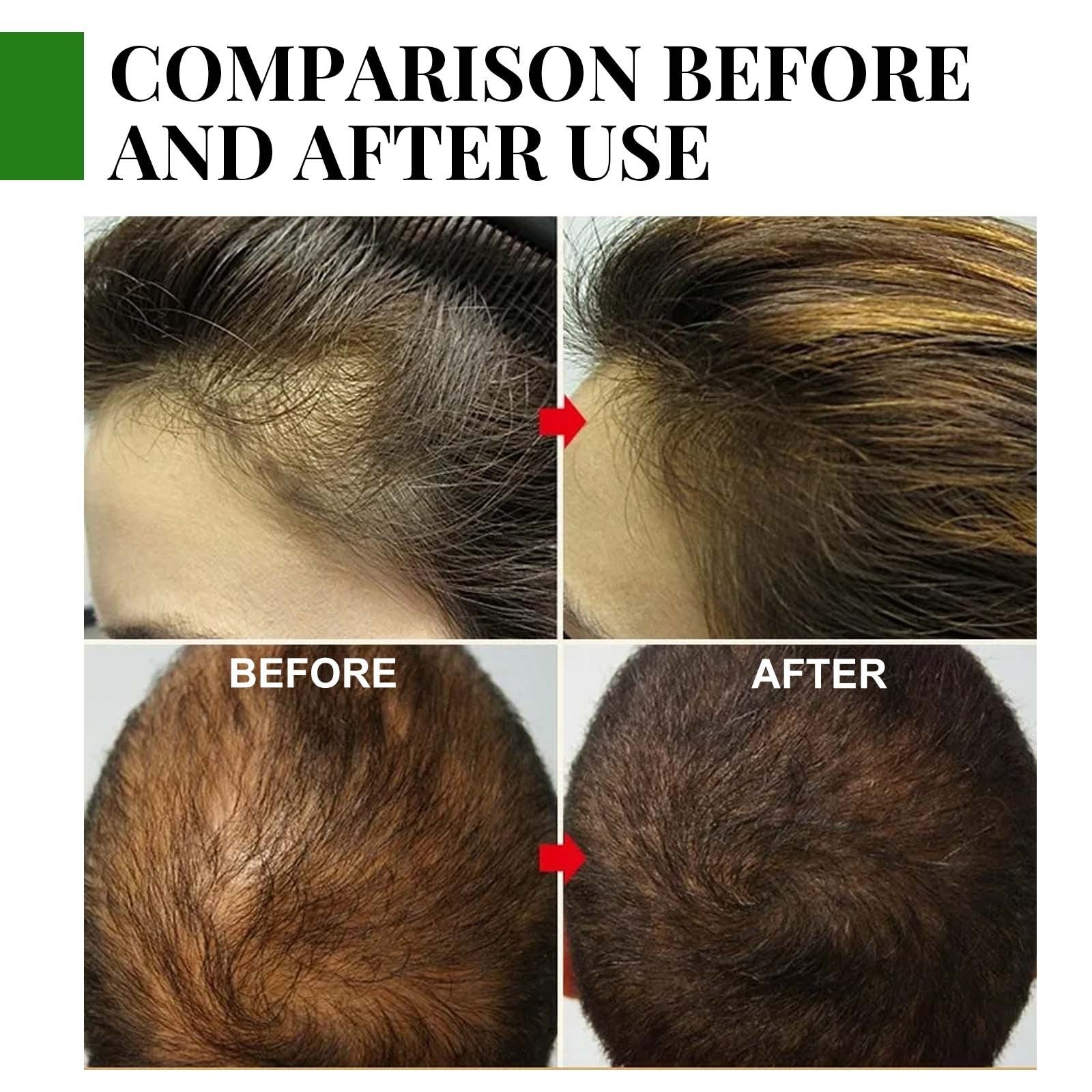 Rosemary Hair Care Capsules Nourish Hair Roots And Prevent Hair Loss