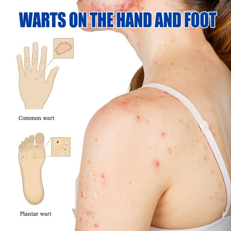 Furuanping Cream Corns Removing Filiform Skin Care