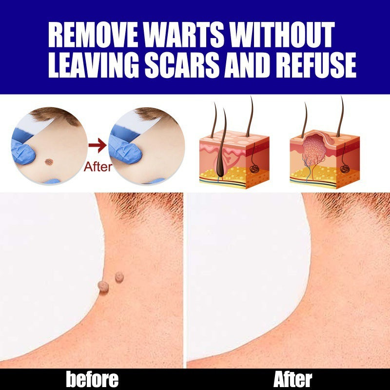Furuanping Cream Corns Removing Filiform Skin Care