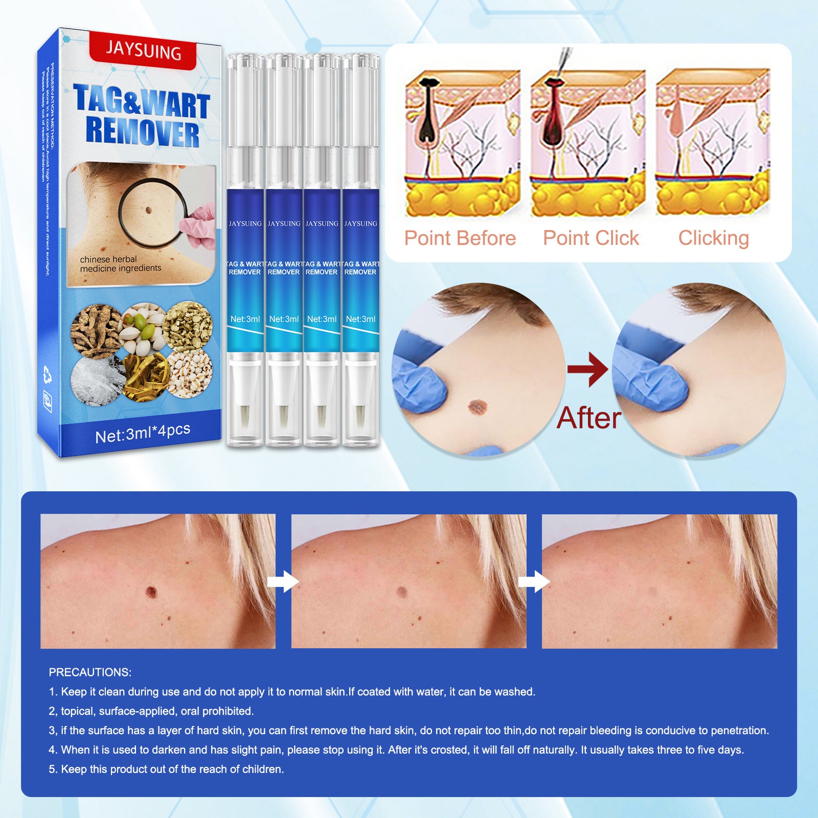 Mole & Wart Removal Pen – Precision Skin Care Treatment